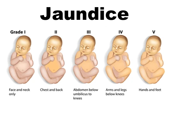 Newborn Diseases